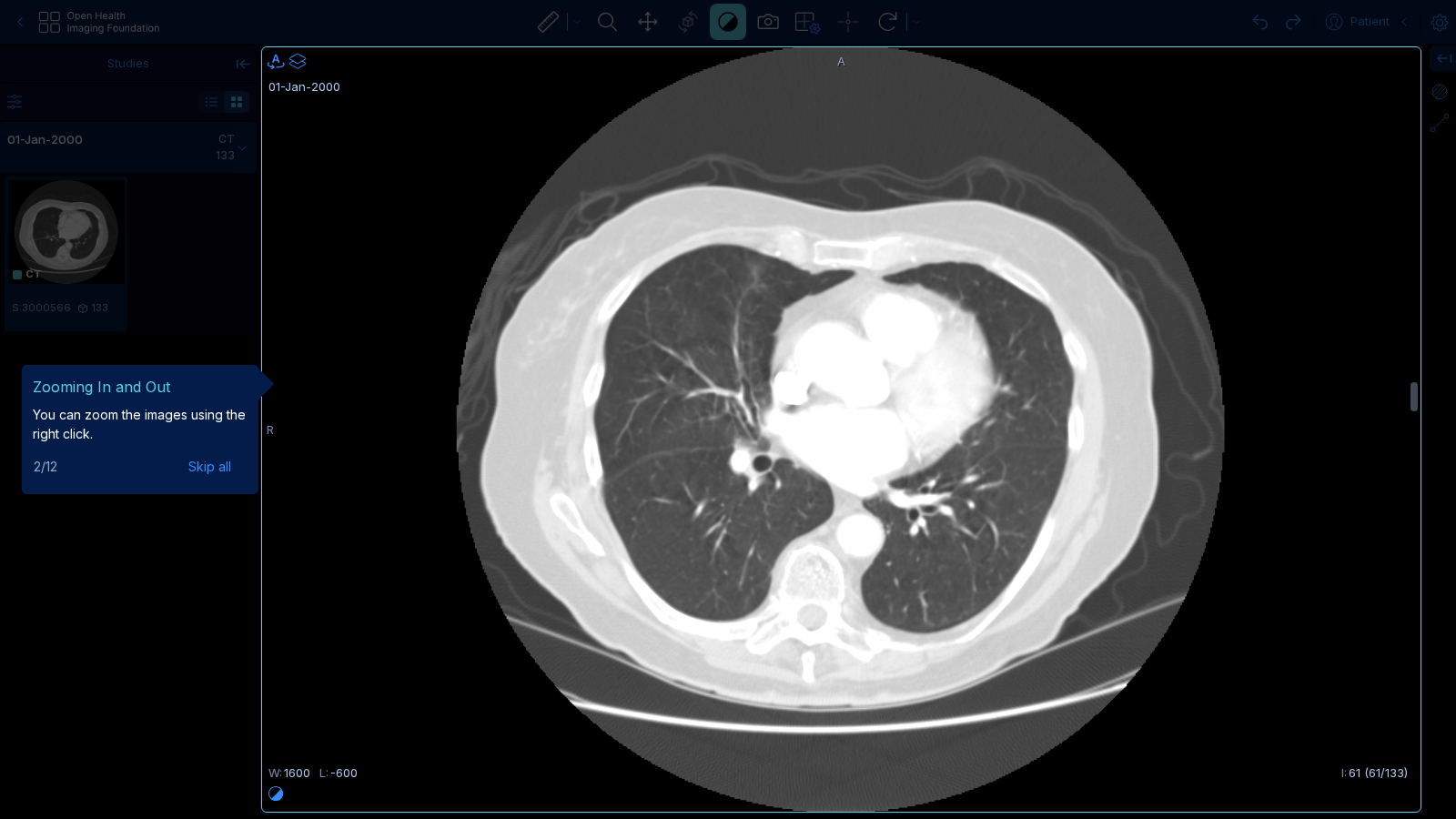 실제 흉부 CT 판독 화면 (lung window)