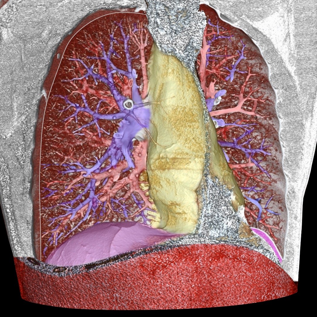 흉부 CT 3D 볼륨 렌더링